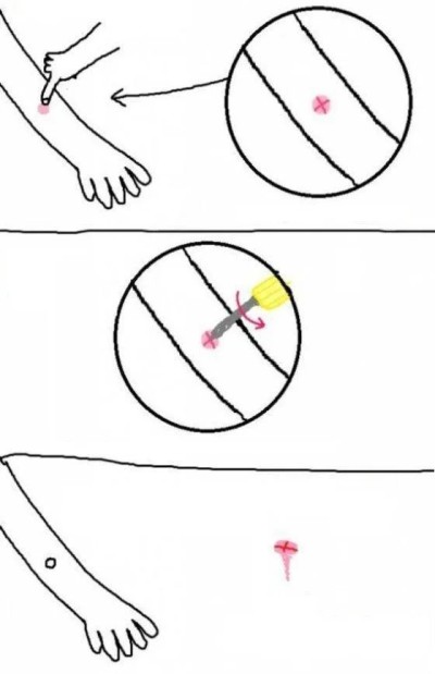 모기에 물리면...치료법