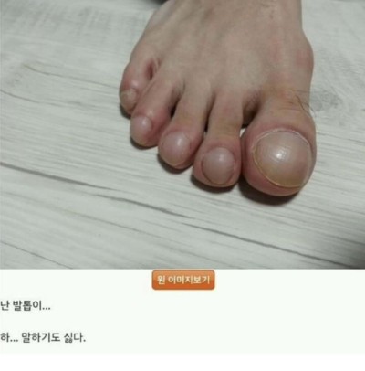 엄지 발가락 어카냐