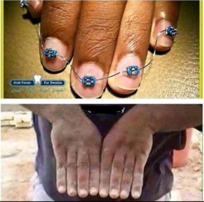 얼척이 없네. 손가락도 이렇게 교정이 된다고??